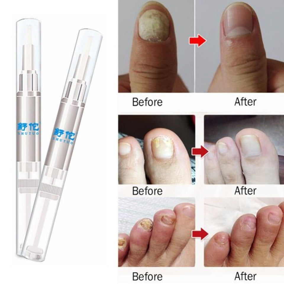 TOTCLEAR Nail Repair Treatment for Toe and Fingernail Fungal India | Ubuy